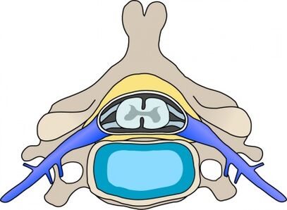 Protabius dans la vertèbre avec une ostéochondrose cervicale