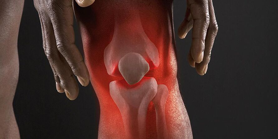 Une sensation de brûlure au niveau du genou est un symptôme de gonarthrose